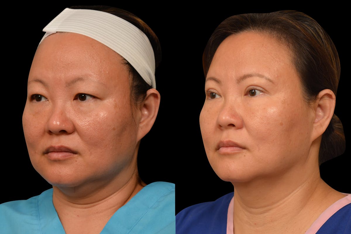 Eyelid Surgery Before & After Gallery - Patient 375482 - Image 2