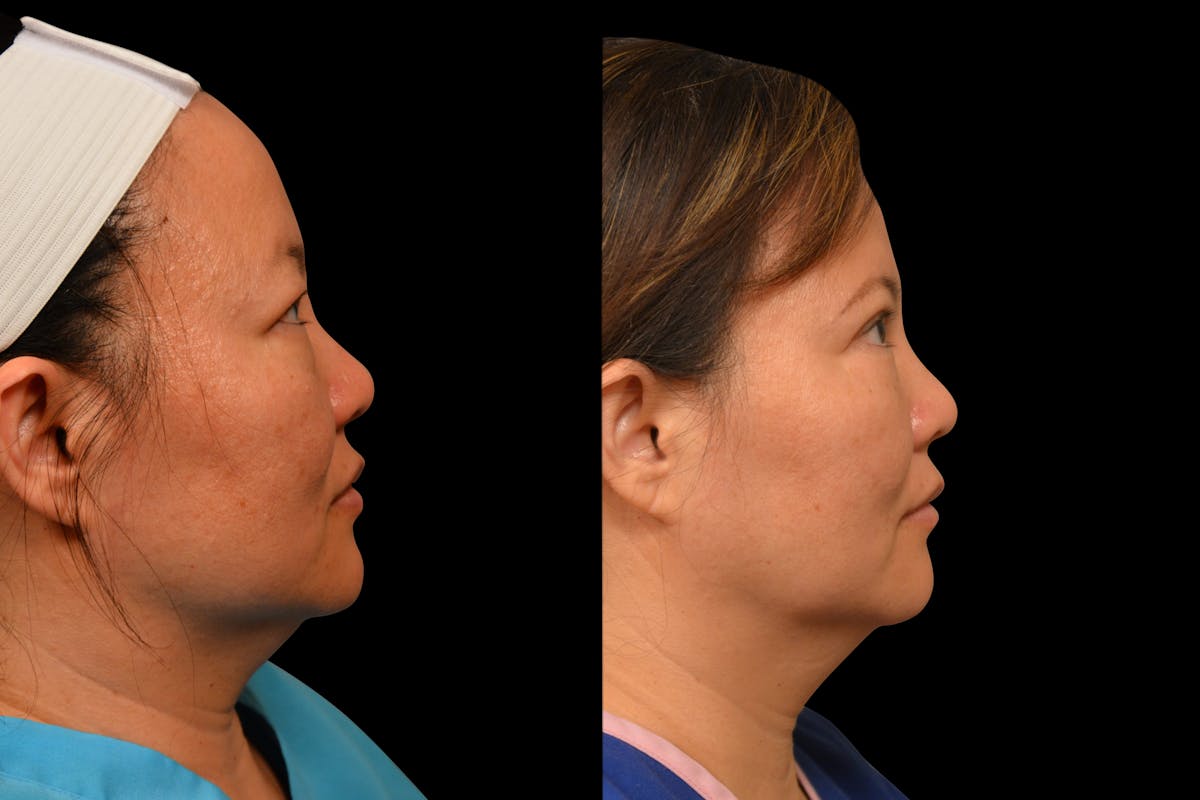 Eyelid Surgery Before & After Gallery - Patient 375482 - Image 4