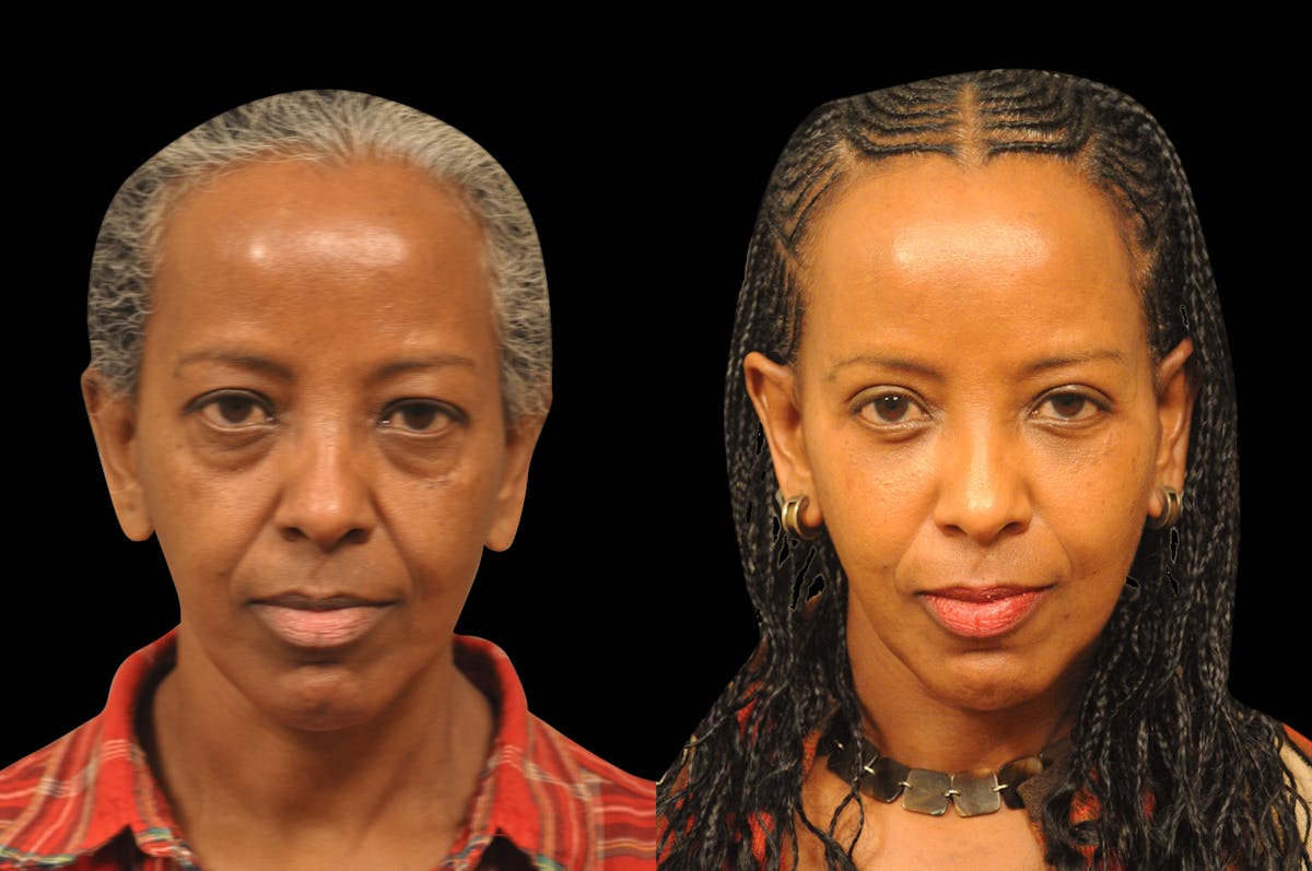 Eyelid Surgery Before & After Gallery - Patient 324914 - Image 5