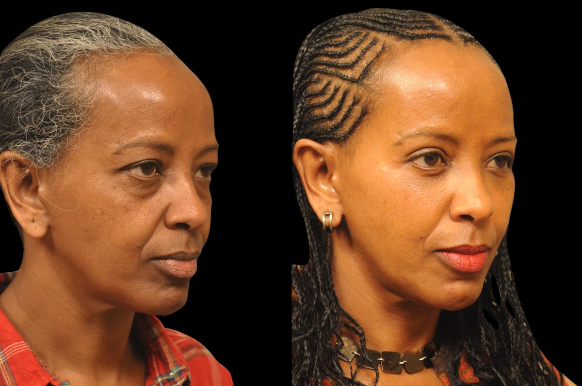 Eyelid Surgery Before & After Gallery - Patient 324914 - Image 4