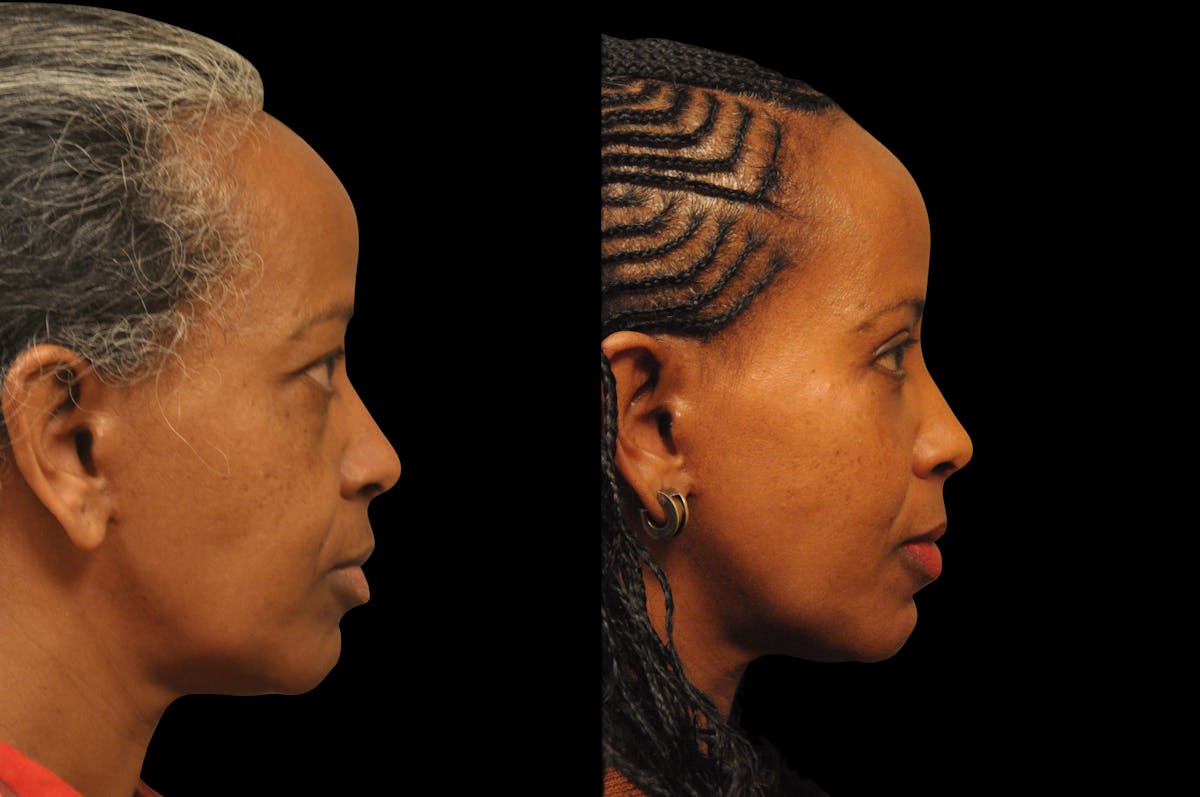 Eyelid Surgery Before & After Gallery - Patient 324914 - Image 4