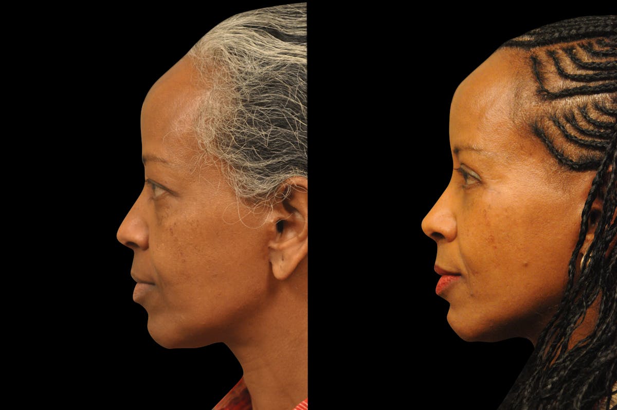 Eyelid Surgery Before & After Gallery - Patient 324914 - Image 3