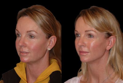 Changes Rapid Lift  Before & After Gallery - Patient 415787 - Image 1