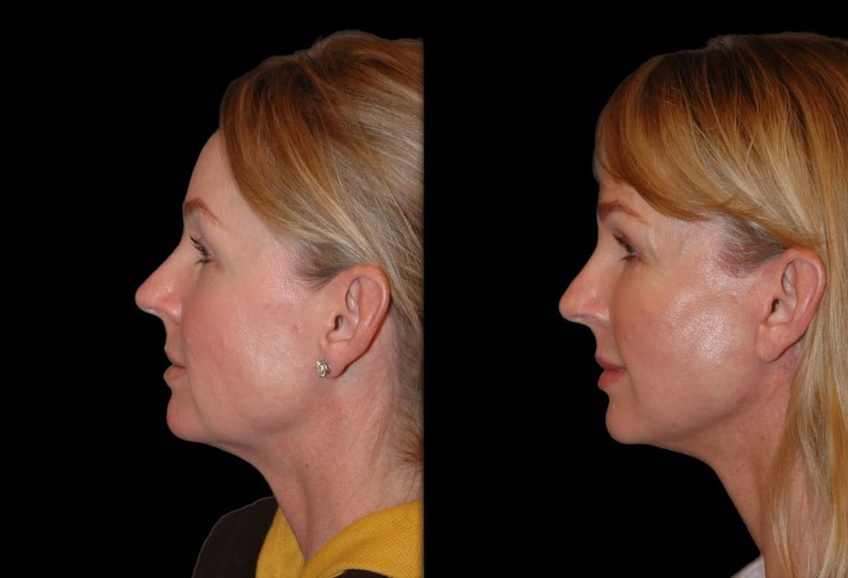 Changes Rapid Lift  Before & After Gallery - Patient 415787 - Image 2