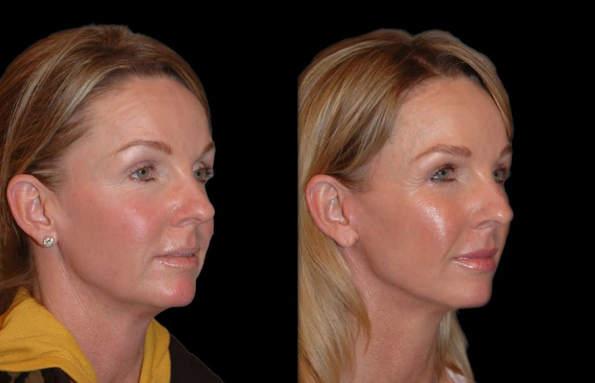Changes Rapid Lift  Before & After Gallery - Patient 415787 - Image 3
