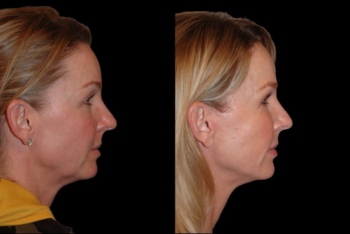 Changes Rapid Lift  Before & After Gallery - Patient 415787 - Image 4