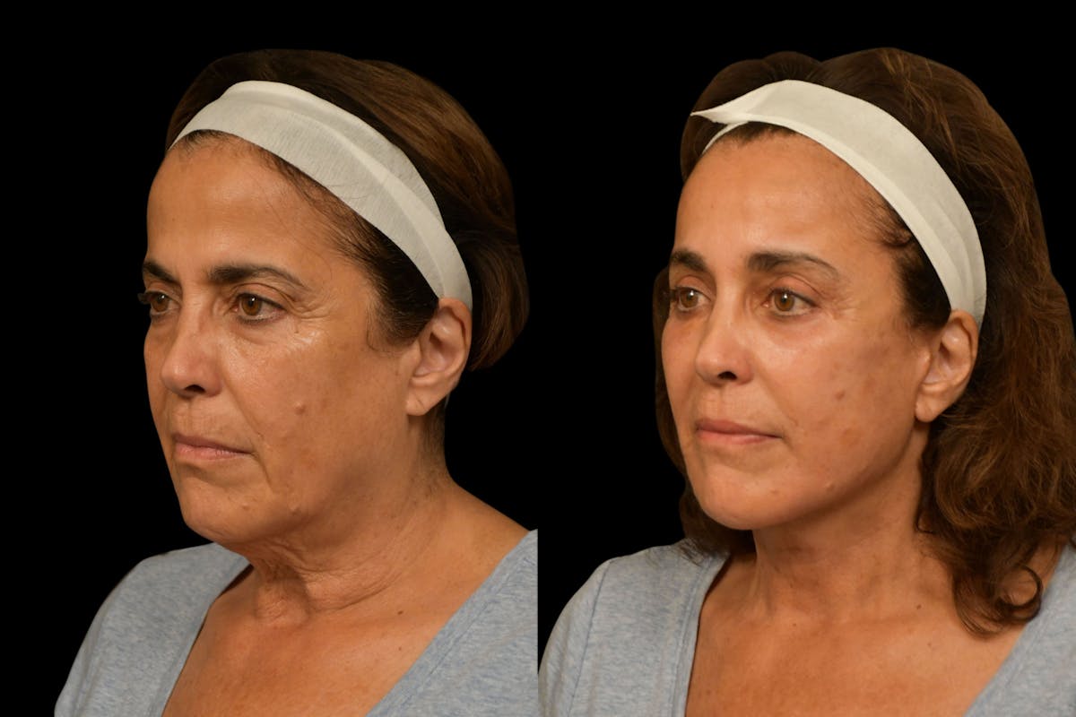Changes Rapid Lift  Before & After Gallery - Patient 721900 - Image 1