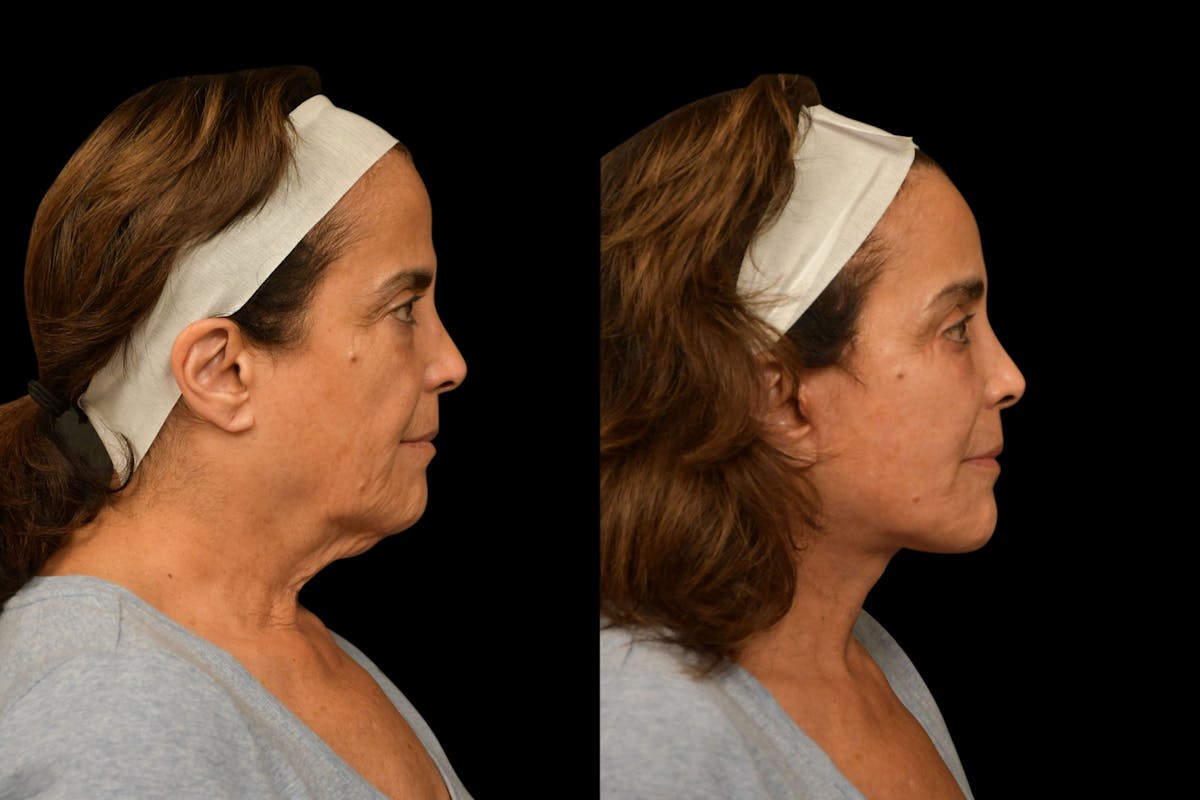Changes Rapid Lift  Before & After Gallery - Patient 721900 - Image 3