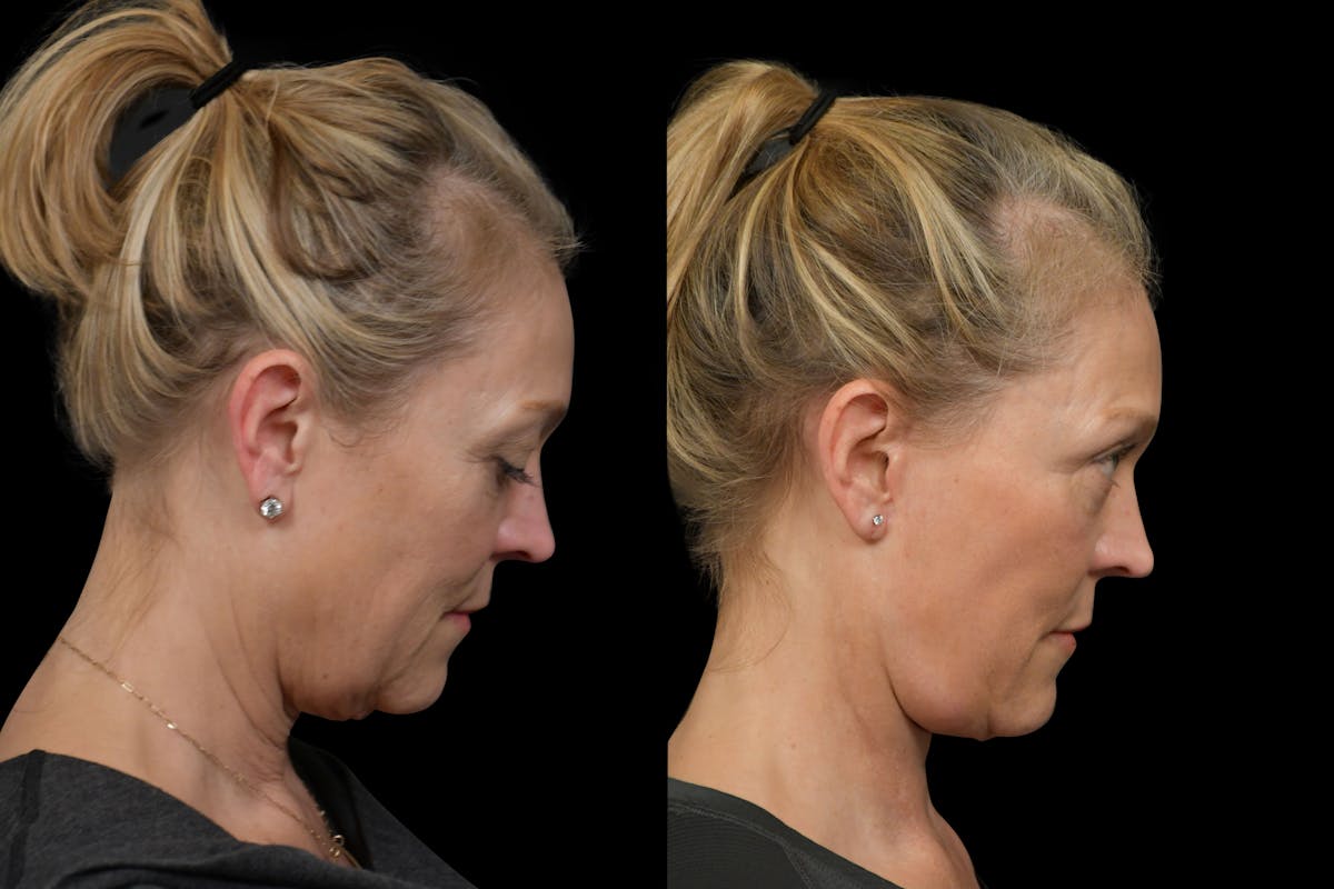 Changes Rapid Lift  Before & After Gallery - Patient 270906 - Image 4