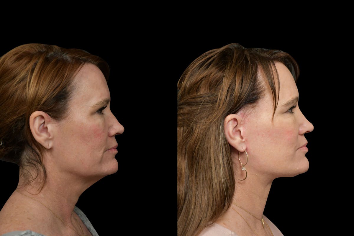 Changes Rapid Lift  Before & After Gallery - Patient 329133 - Image 4