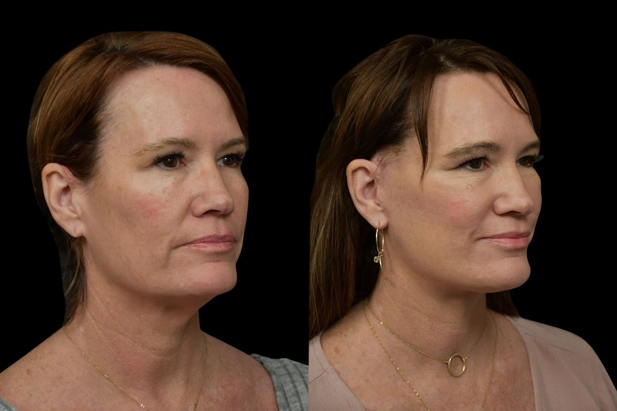 Changes Rapid Lift  Before & After Gallery - Patient 329133 - Image 5