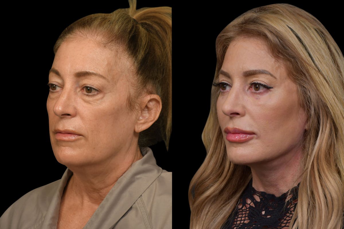 Changes Rapid Lift  Before & After Gallery - Patient 216436 - Image 1
