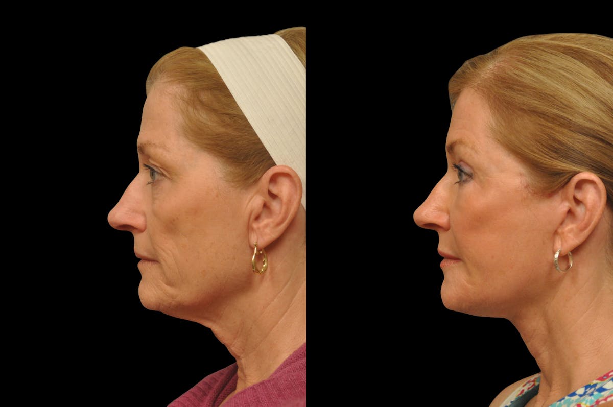 Changes Rapid Lift  Before & After Gallery - Patient 410812 - Image 2