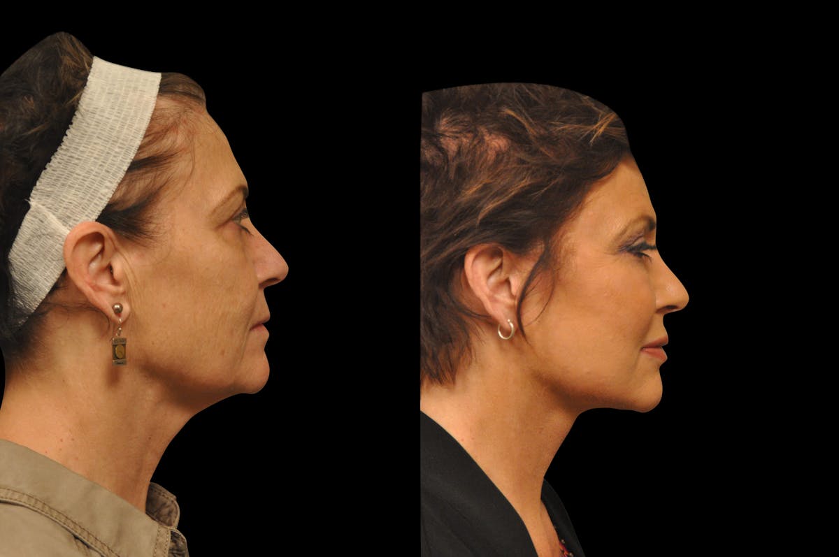 Changes Rapid Lift  Before & After Gallery - Patient 352439 - Image 4