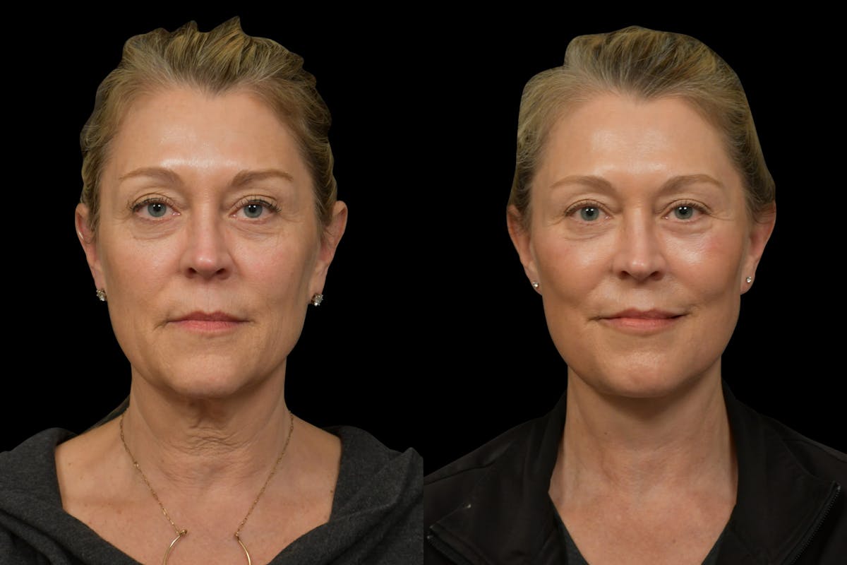 Neck Lift Before & After Gallery - Patient 316456 - Image 7