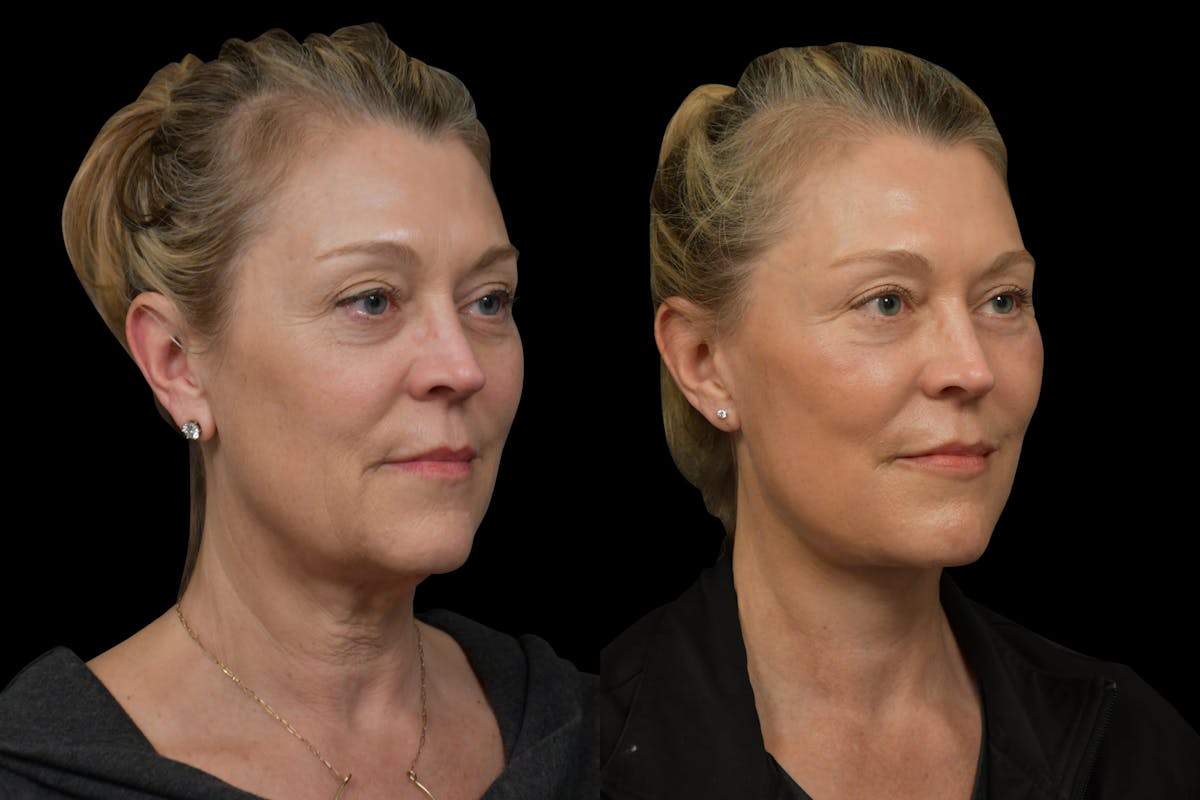 Neck Lift Before & After Gallery - Patient 316456 - Image 4