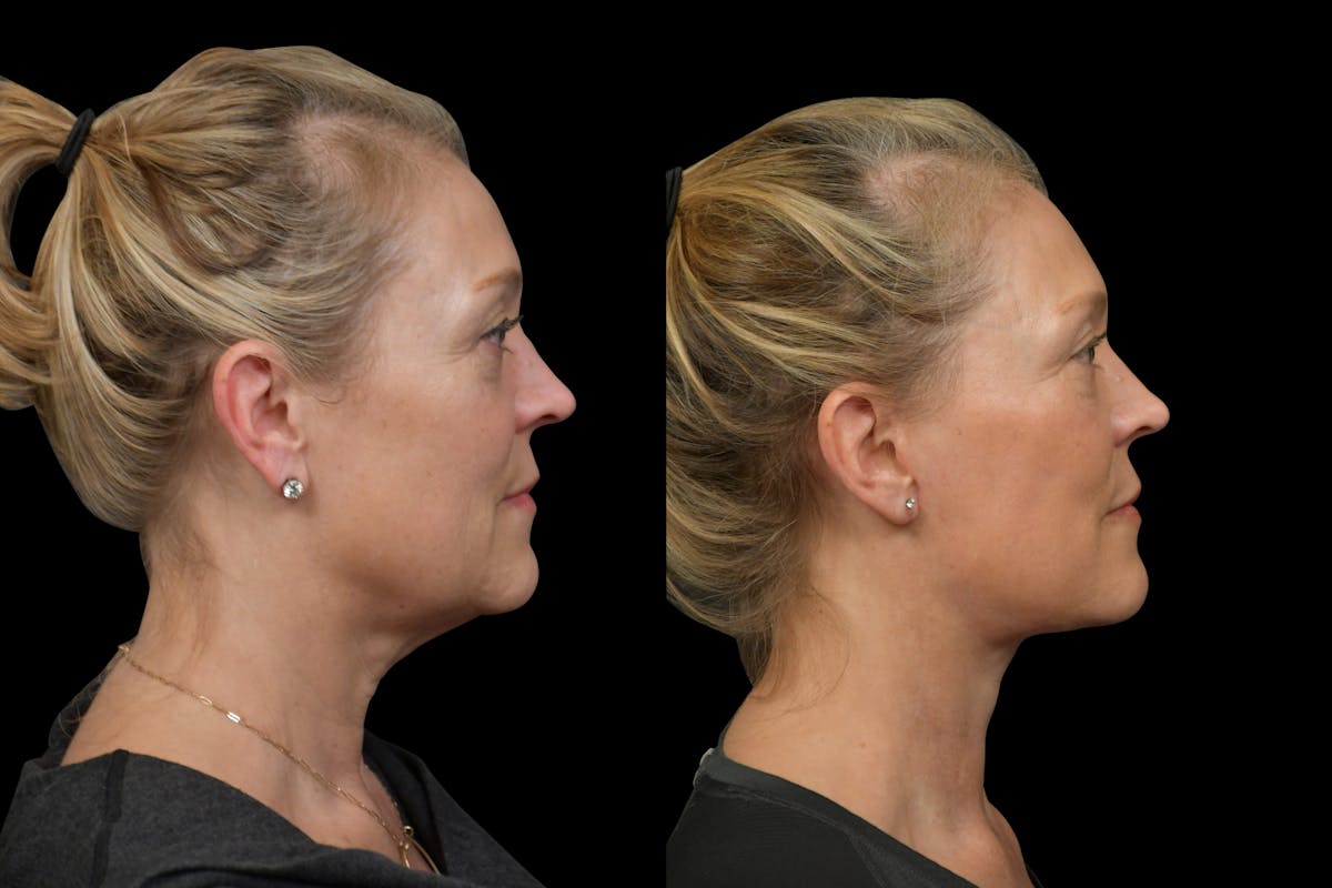 Neck Lift Before & After Gallery - Patient 316456 - Image 5