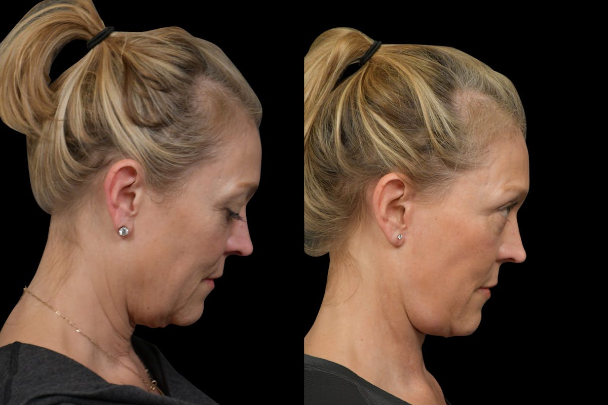 Neck Lift Before & After Gallery - Patient 316456 - Image 6