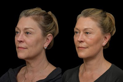 Neck Lift Before & After Gallery - Patient 316456 - Image 1