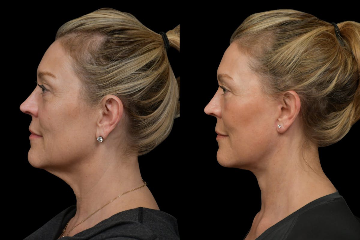 Neck Lift Before & After Gallery - Patient 316456 - Image 2