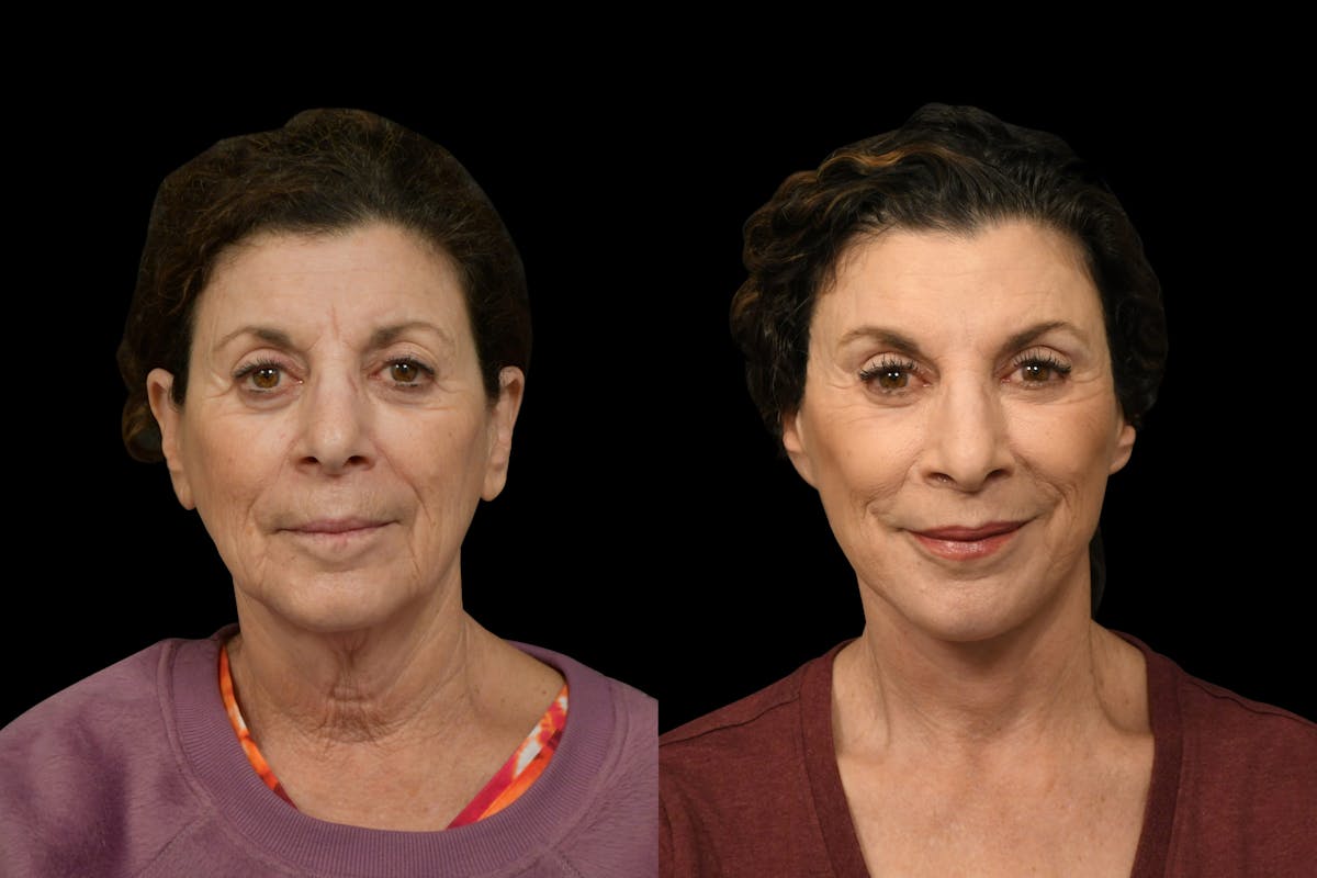 Neck Lift Before & After Gallery - Patient 927234 - Image 5