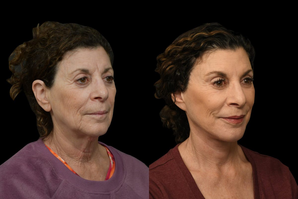 Neck Lift Before & After Gallery - Patient 927234 - Image 3
