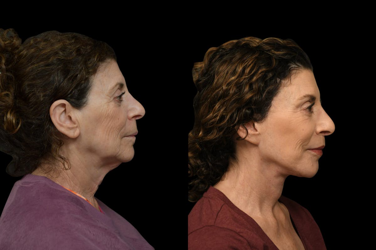 Neck Lift Before & After Gallery - Patient 927234 - Image 4