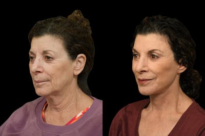 Neck Lift Before & After Gallery - Patient 927234 - Image 1