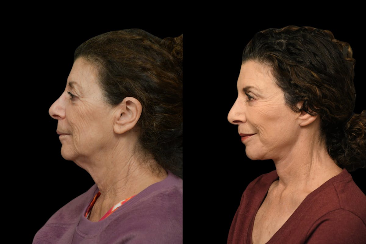 Neck Lift Before & After Gallery - Patient 927234 - Image 2
