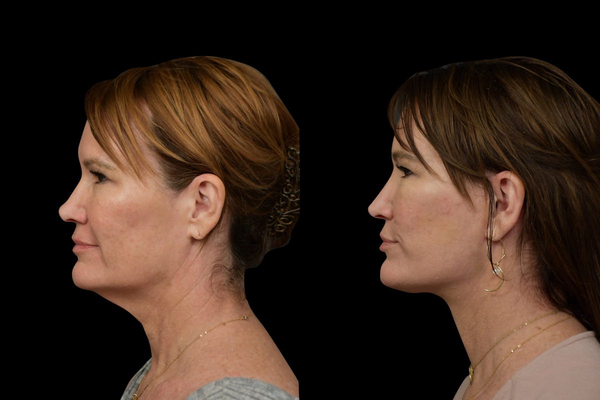 Neck Lift Before & After Gallery - Patient 315567 - Image 2