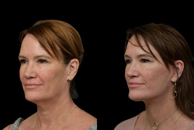 Neck Lift Before & After Gallery - Patient 315567 - Image 1