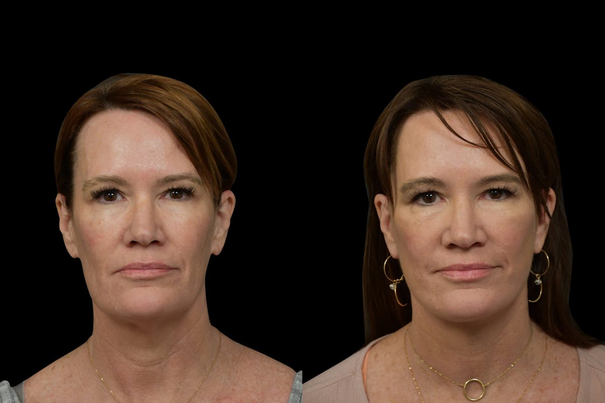 Neck Lift Before & After Gallery - Patient 315567 - Image 5