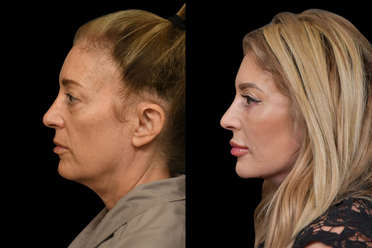 Neck Lift Before & After Gallery - Patient 452190 - Image 2