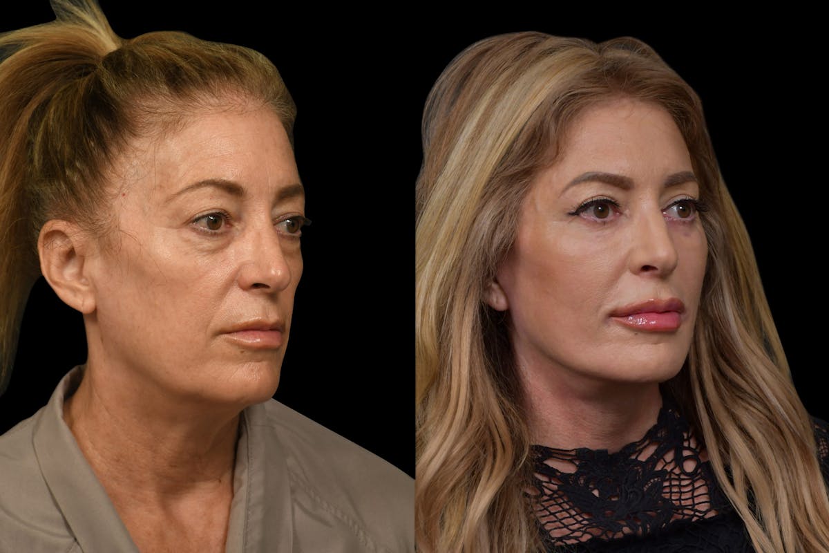 Neck Lift Before & After Gallery - Patient 452190 - Image 3