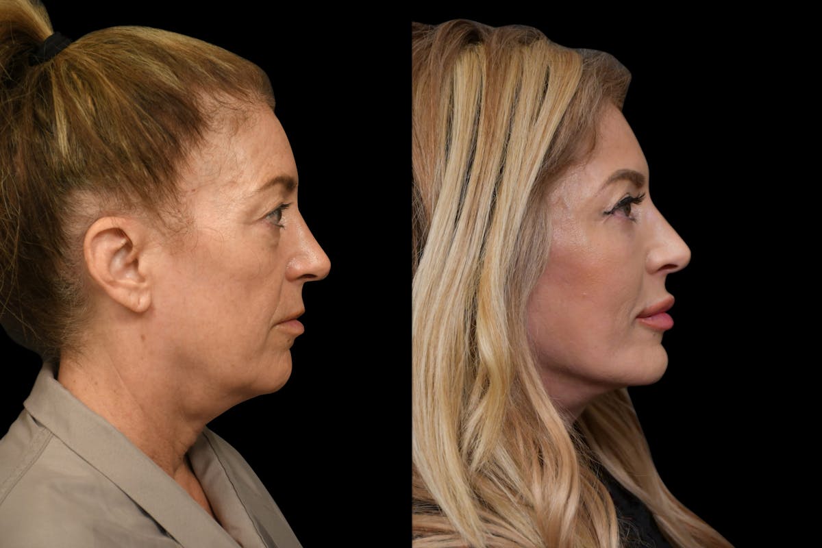 Neck Lift Before & After Gallery - Patient 452190 - Image 4