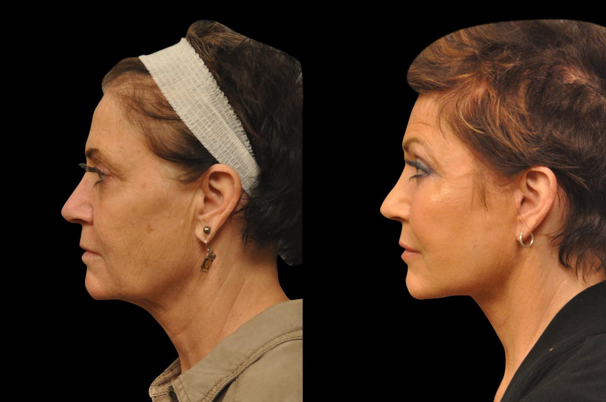 Neck Lift Before & After Gallery - Patient 110062 - Image 2