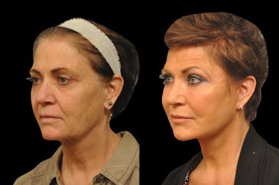 Neck Lift Before & After Gallery - Patient 110062 - Image 1