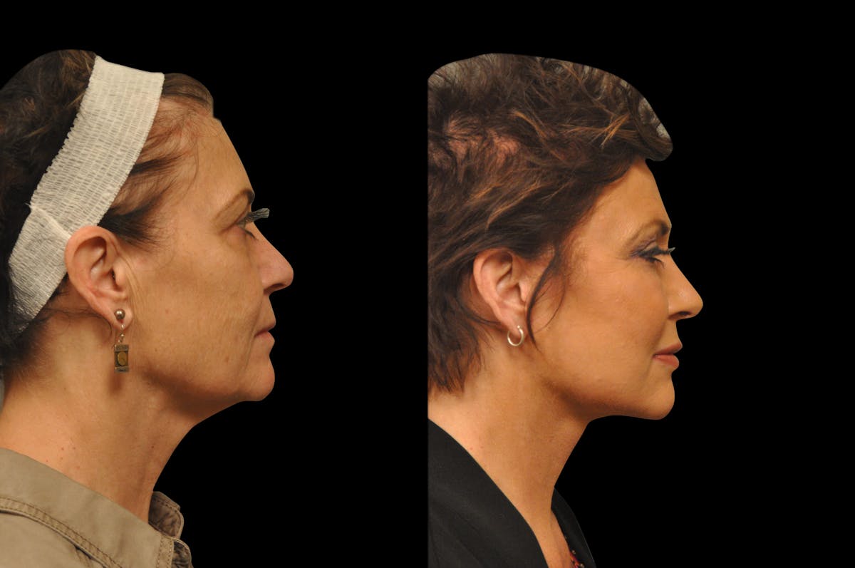 Neck Lift Before & After Gallery - Patient 110062 - Image 3