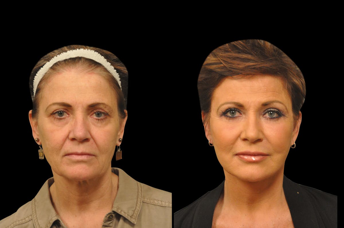 Neck Lift Before & After Gallery - Patient 110062 - Image 5