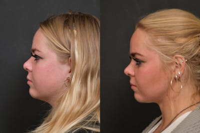 Neck Lift Before & After Gallery - Patient 384319 - Image 1