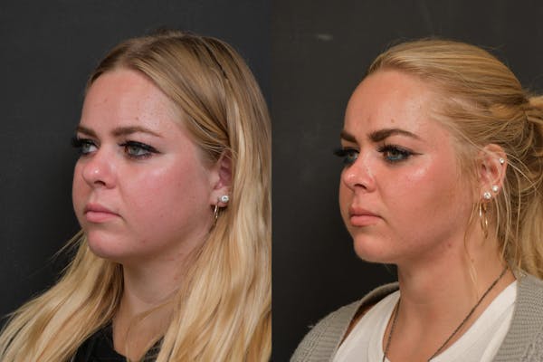 Neck Lift Before & After Gallery - Patient 384319 - Image 1