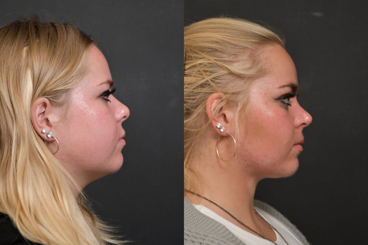 Neck Lift Before & After Gallery - Patient 384319 - Image 3