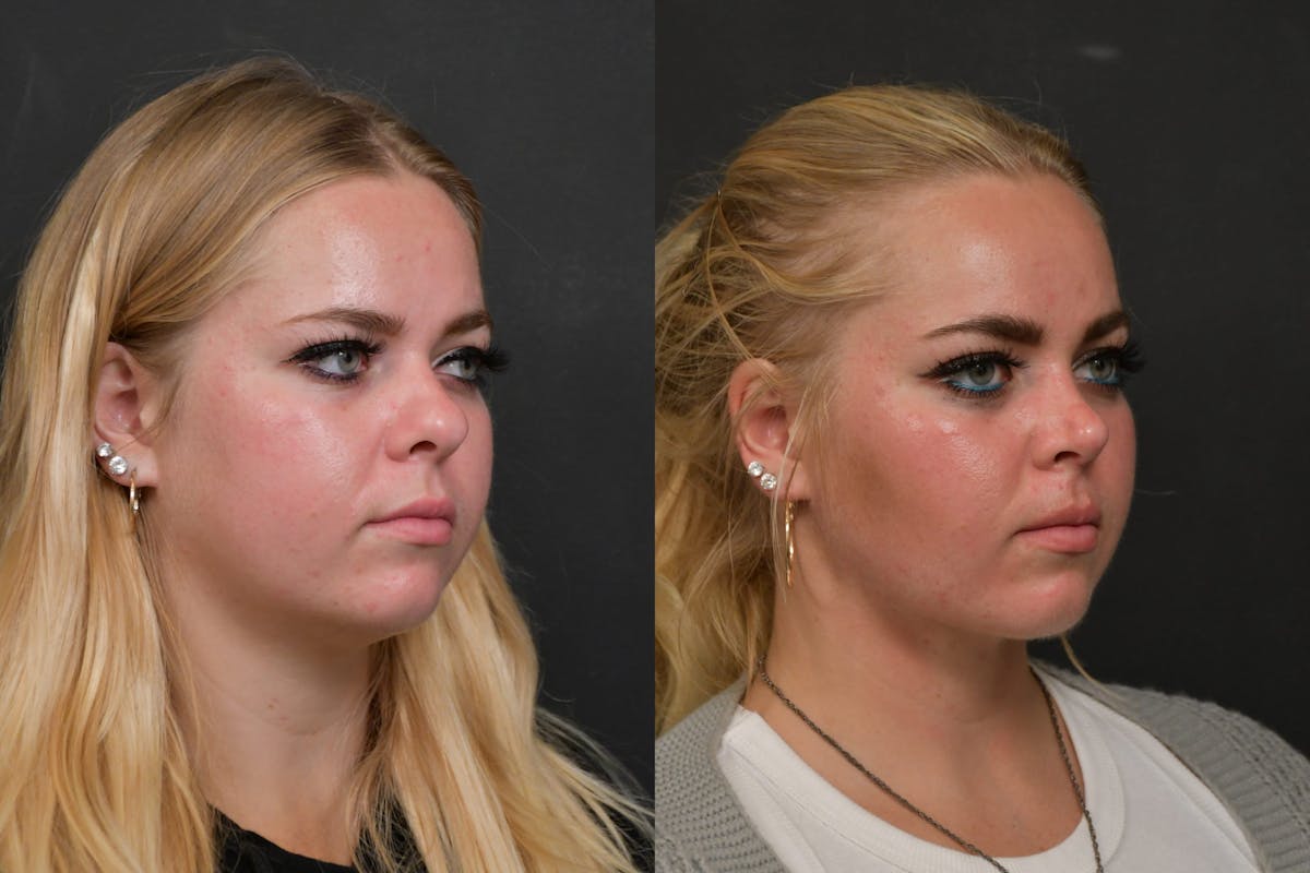 Neck Lift Before & After Gallery - Patient 384319 - Image 4