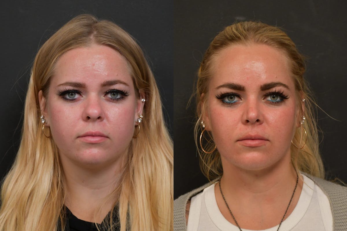 Neck Lift Before & After Gallery - Patient 384319 - Image 5