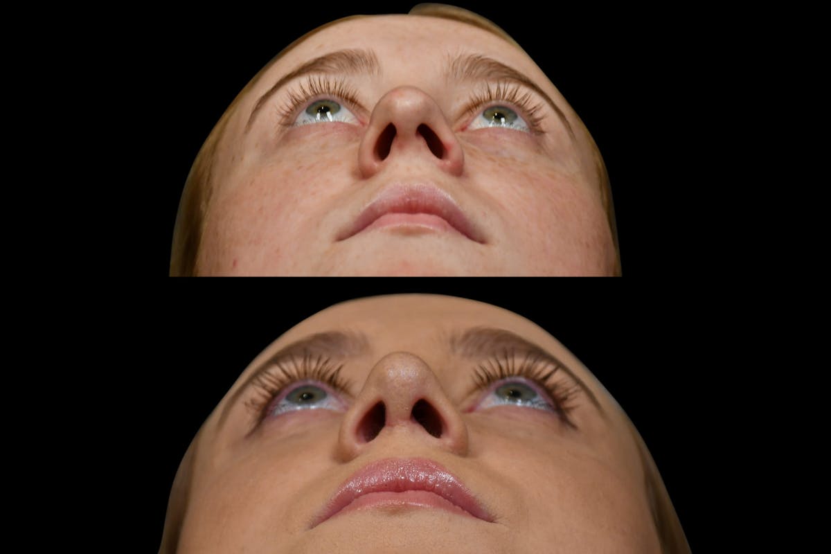 Rhinoplasty Before & After Gallery - Patient 220143 - Image 7