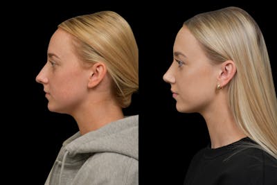 Rhinoplasty Before & After Gallery - Patient 220143 - Image 1