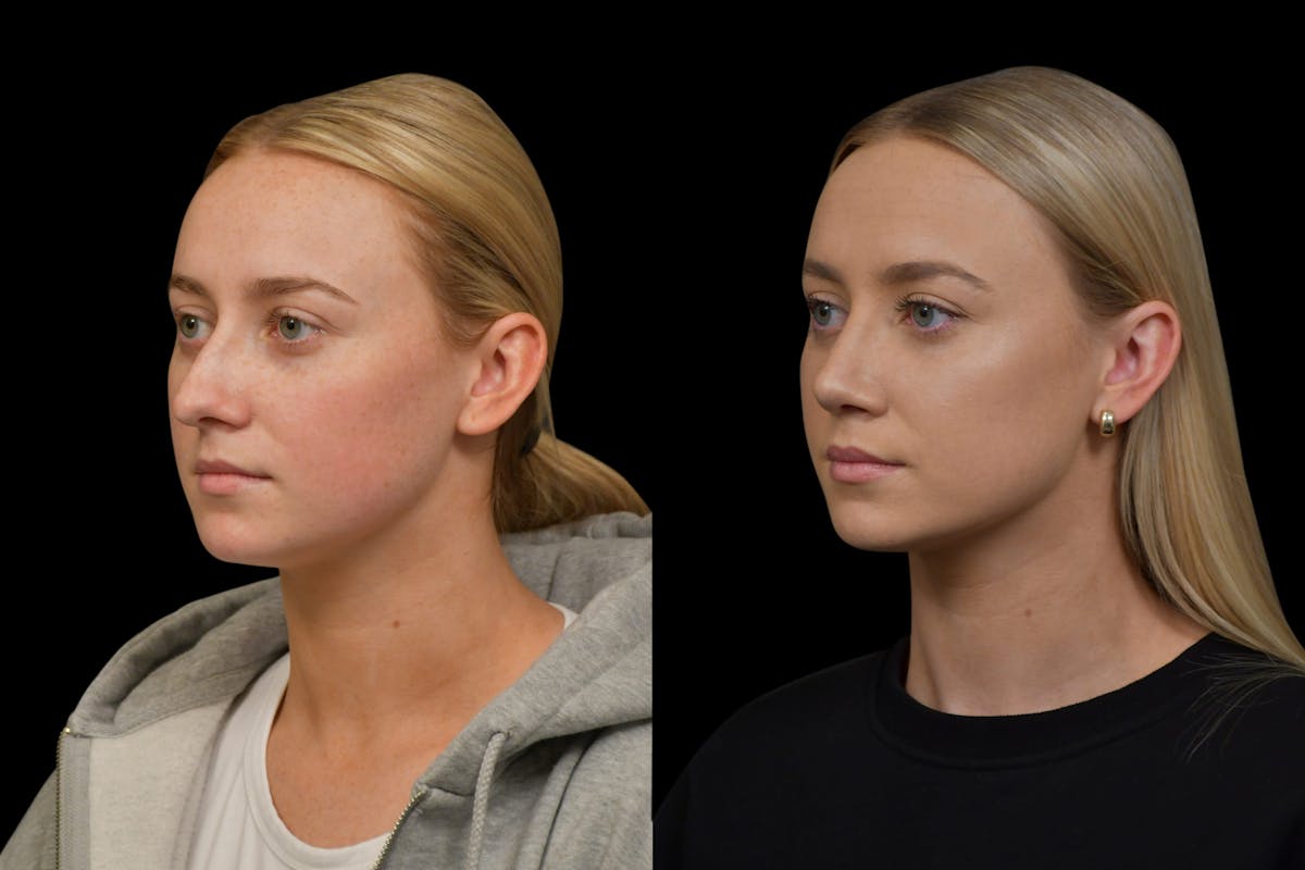Rhinoplasty Before & After Gallery - Patient 220143 - Image 3