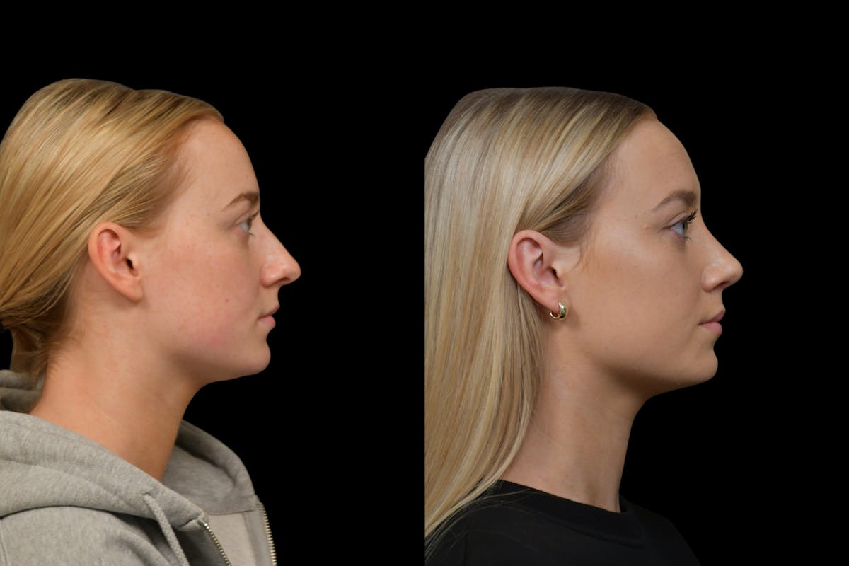 Rhinoplasty Before & After Gallery - Patient 220143 - Image 4