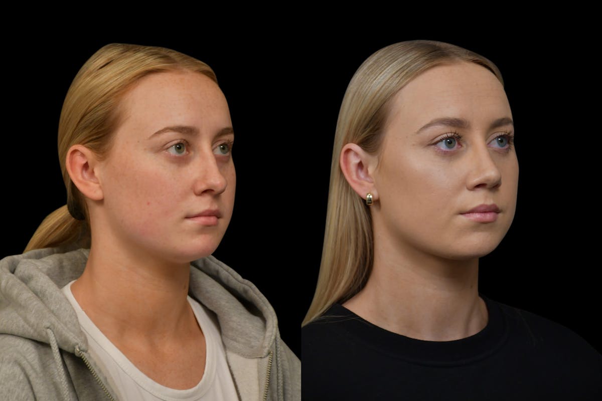 Rhinoplasty Before & After Gallery - Patient 220143 - Image 4