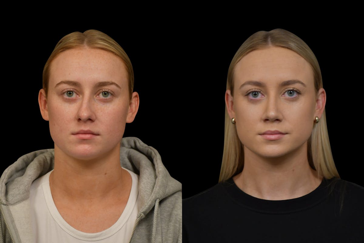 Rhinoplasty Before & After Gallery - Patient 220143 - Image 6